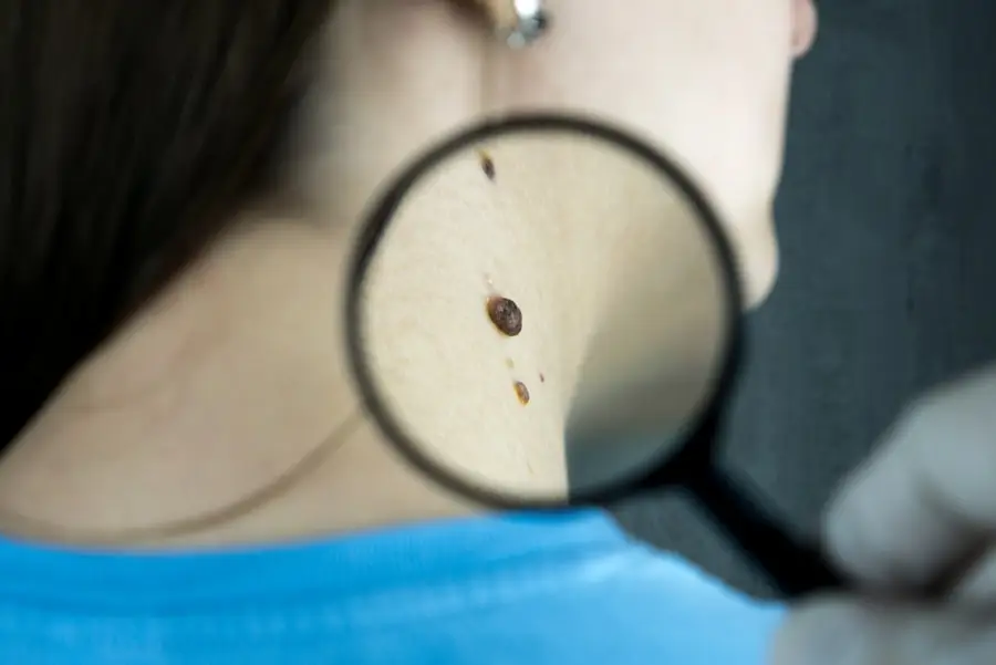 Mole check using a magnifier during a skin examination